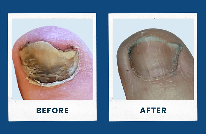 Primary Foot Care Center, Inc. | Fractures of the Foot, Hammertoes and Vibration Therapy